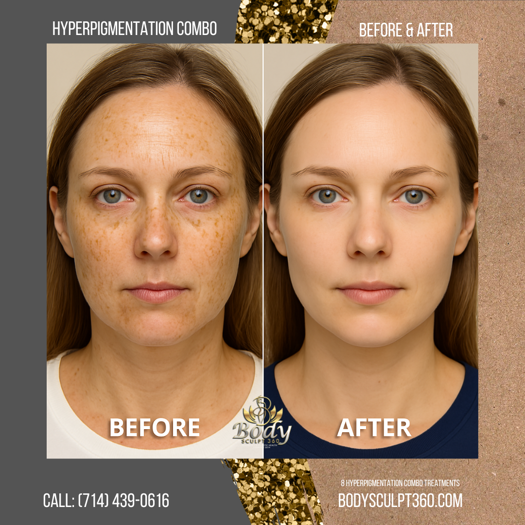 Hyperpigmentation Treatment Package Body Sculpt 360°™ Aesthetics & Holistic Health