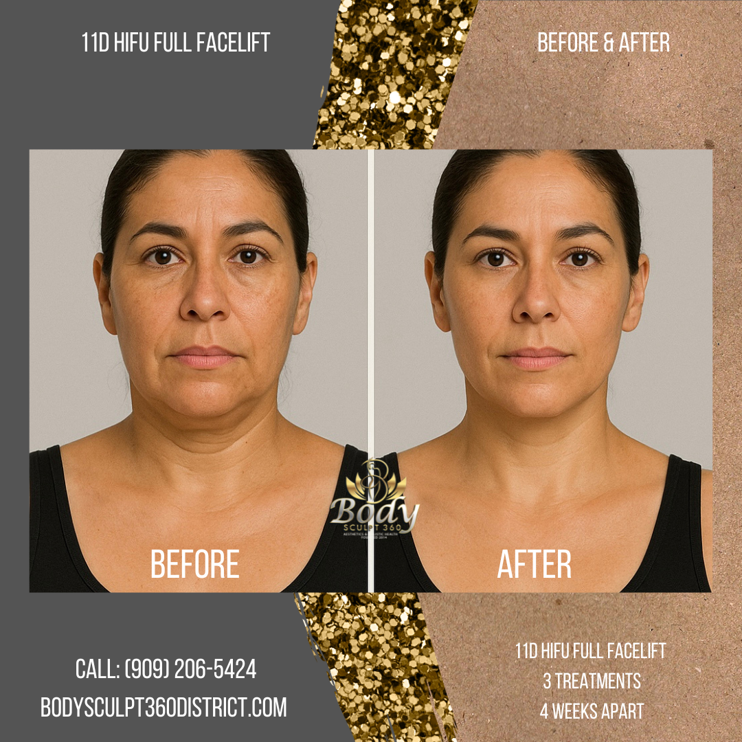 11D HIFU Full Facelift Introductory Offer | Non-Surgical Facelift Body Sculpt 360° at The District
